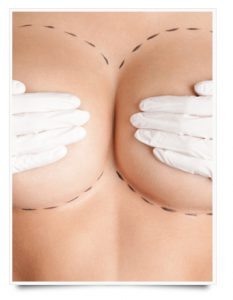 mamoplastia reduccion sevilla 233x300 - Todo lo que debes saber de una reducción de pecho