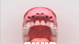 implantes dentales sevilla 300x169 - Implantes dentales: todo lo que debes saber antes de comenzar el tratamiento