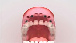 Implantes dentales: todo lo que debes saber antes de comenzar el tratamiento