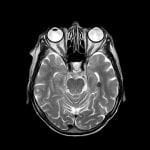 Etapas para la aplicación de radioterapia