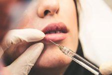 Técnica del relleno de labios en Sevilla para tu rostro