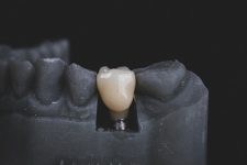 Implantología: todos los consejos para este tratamiento 8 Implantología: todos los consejos para este tratamiento